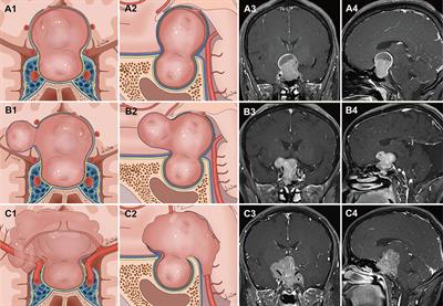 Identification of the Extradural and Intradural Extension of Pituitary Adenomas to the Suprasellar Region: Classification, Surgical Strategies, and Outcomes